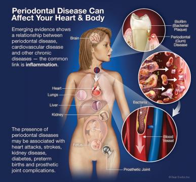 periodontal disease affects heart body